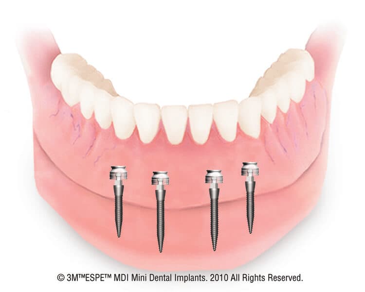 denture stabilization Mayfair