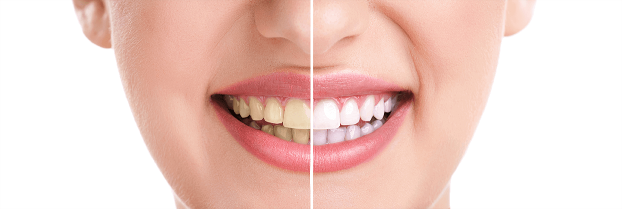 Teeth Whitening in Mayfair