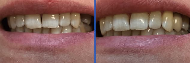 implant