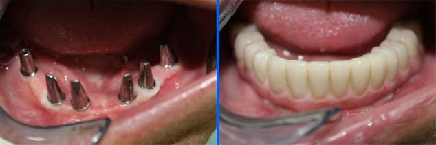 implant