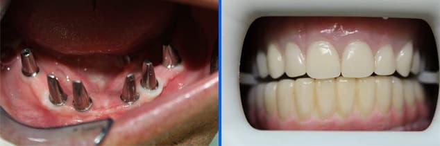 implant