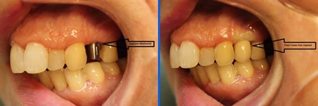 implant