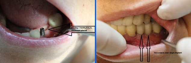 implant