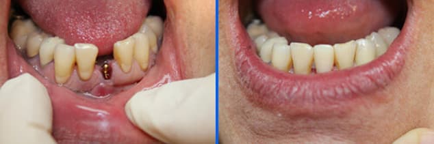 implant