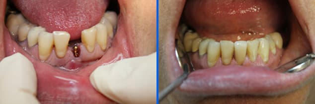 implant