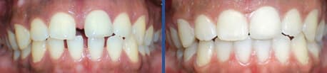 invisalign