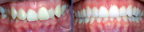 invisalign