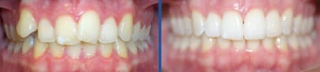 invisalign