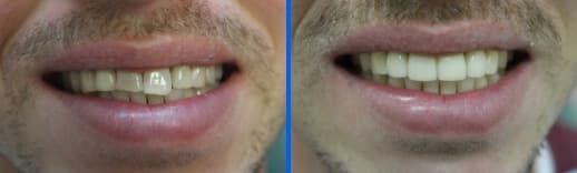 veneers